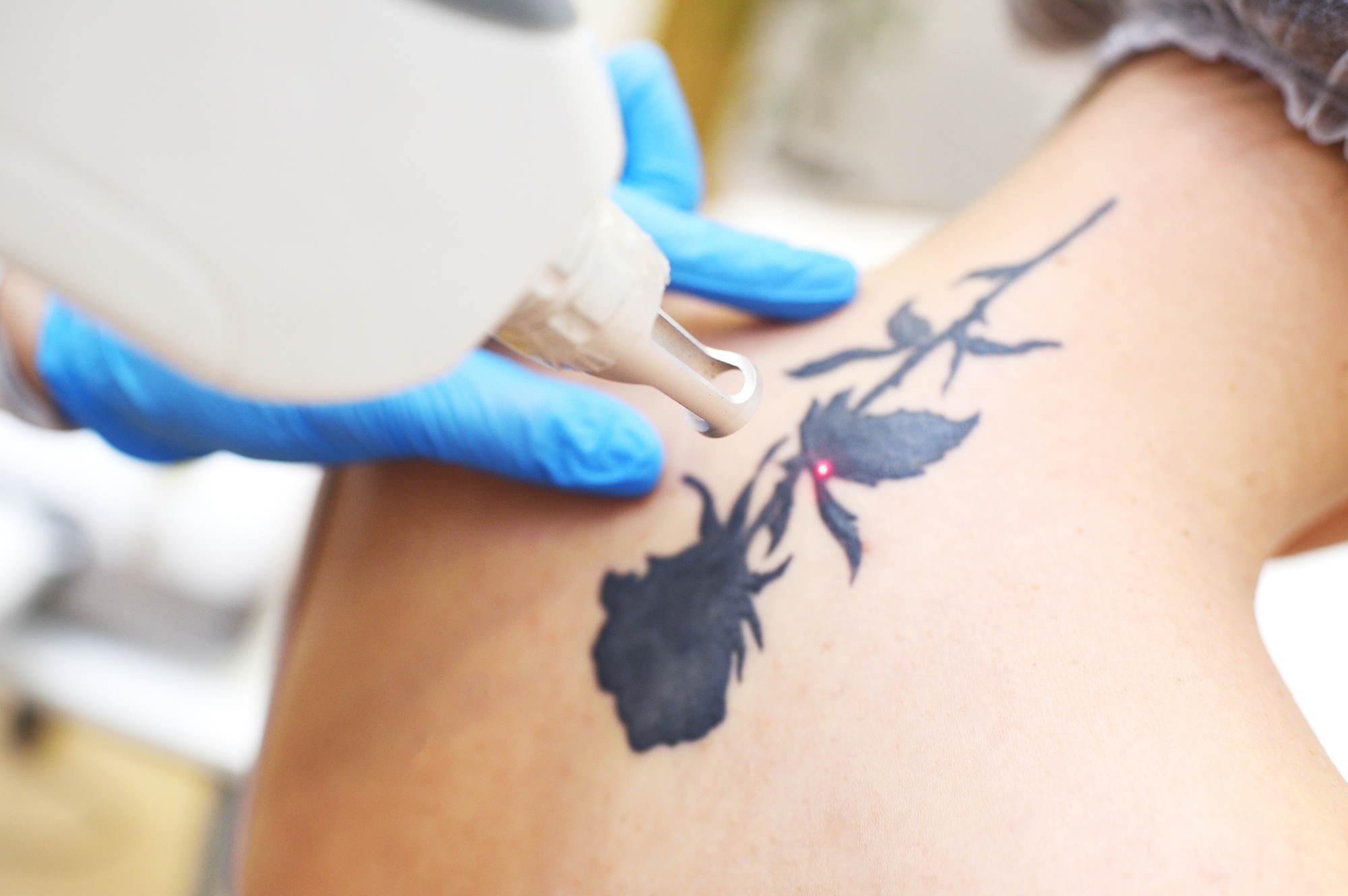cosmetologist removes the tattoo to the patient using a neodymium laser in a modern clinic. Hardware