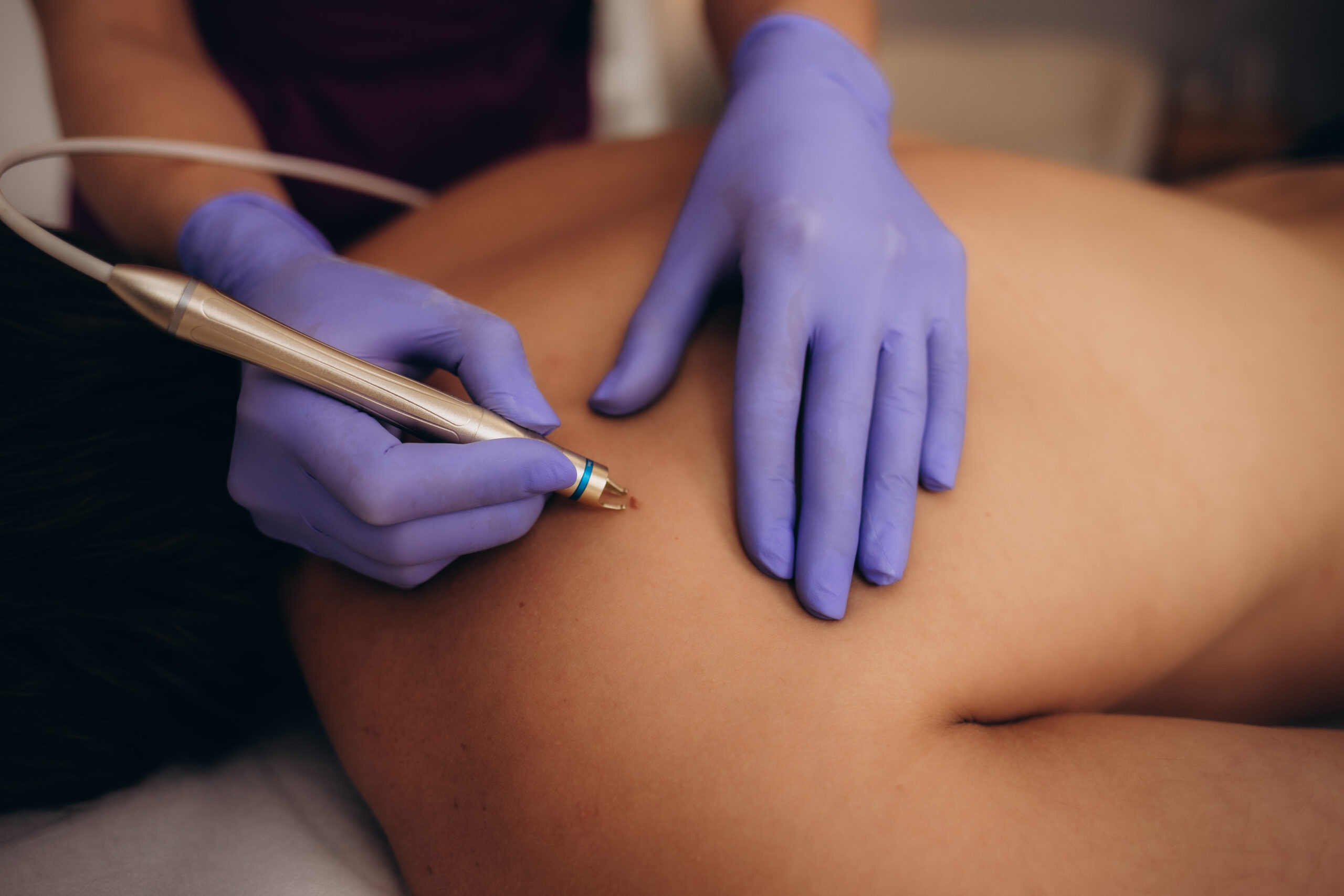 Electrolysis (Epilation level 3)